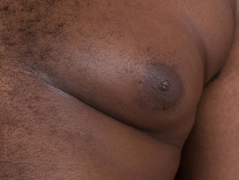 Paul Wilson Aesthetics - Enlarged male breasts