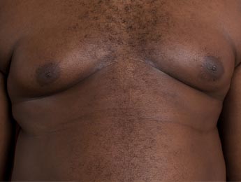 Paul Wilson Aesthetics - Enlarged male breasts