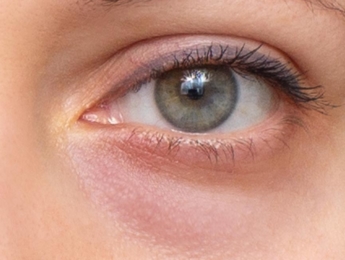Paul Wilson Aesthetics - Eye Bags