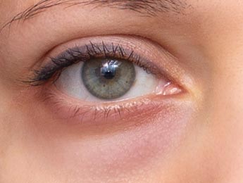 Paul Wilson Aesthetics - Eye Bags