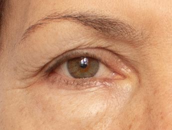 Paul Wilson Aesthetics - Lateral hooding