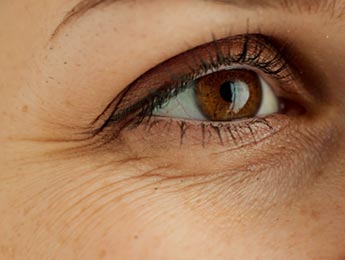 Paul Wilson Aesthetics Lines and wrinkles