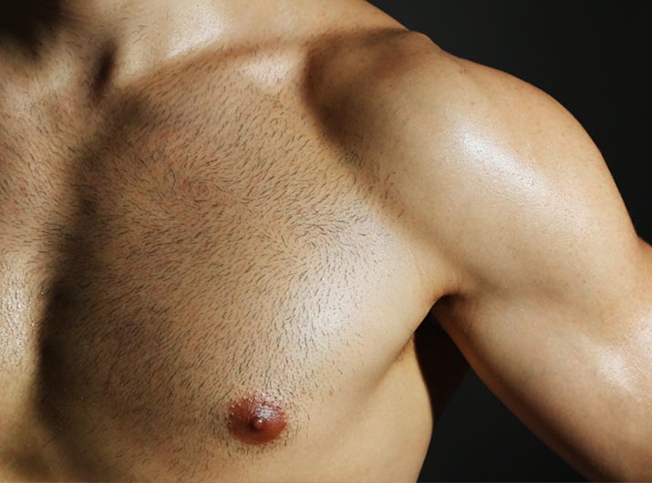 Paul Wilson Aesthetics - Male Breast Reduction Procedure Video