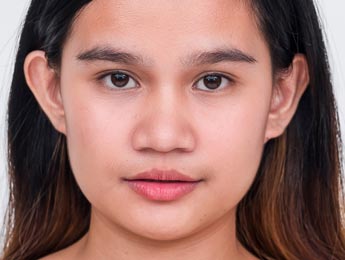 Paul Wilson Aesthetics - Prominent ears