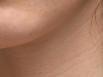 Paul Wilson Aesthetics - Sagging skin Skin laxity